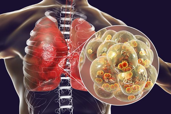 Nguyên nhân và triệu chứng của bệnh phổi