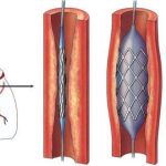 Những trường hợp đủ điều kiện đặt stent graft 