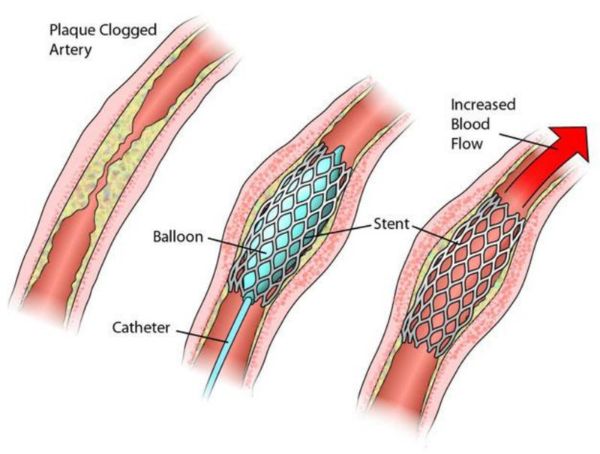 Quy trình thực hiện kỹ thuật đặt stent graft 